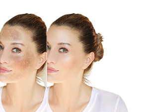 Hyperpigmentation