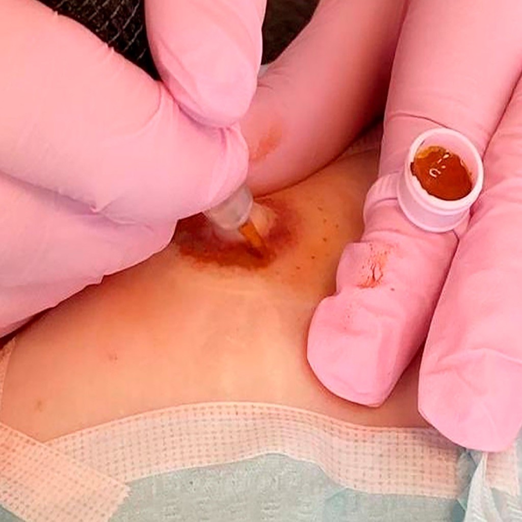 Professionel tr�ning i medicinsk mikropigmentering