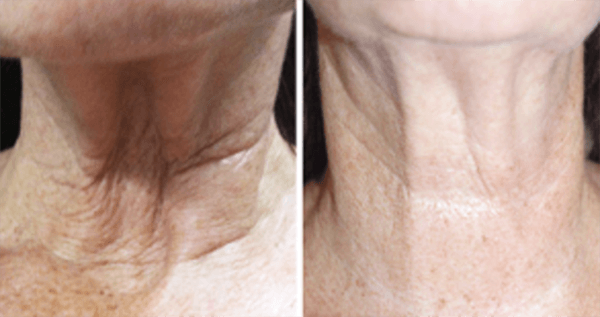 MESO EYE LIFT  case C
