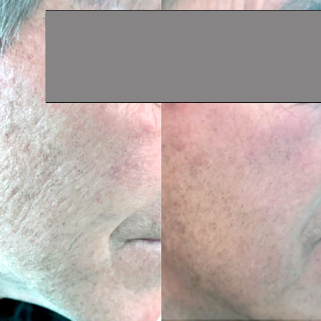 MESO LipVolume Serum � Produktfoto