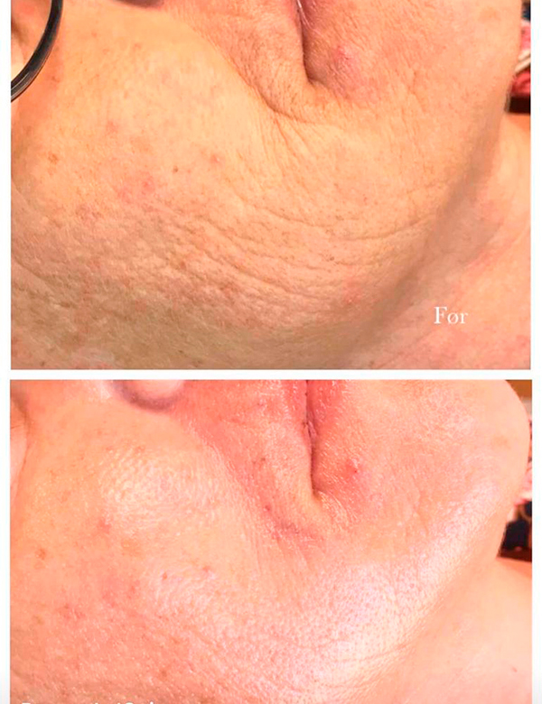 Produkt  MESO CHEEK LIFT+ (1)