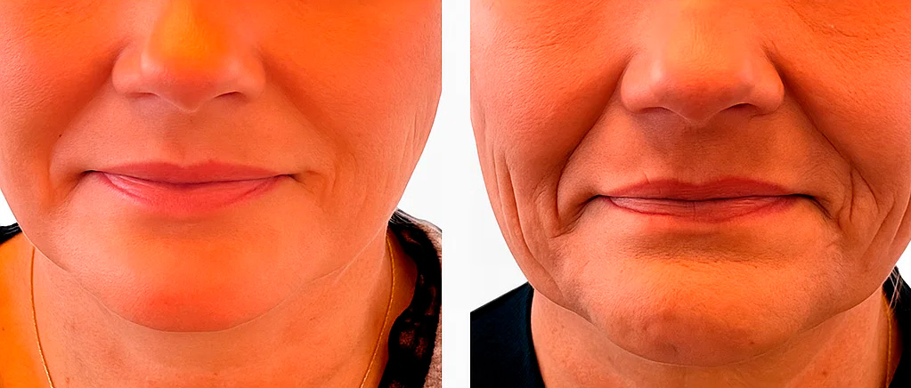 MESO CHEEK LIFT  case C