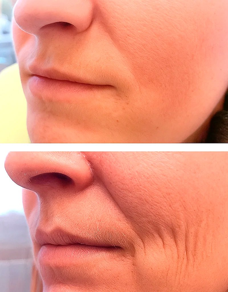 Produkt  MESO CHEEK LIFT+ (2)