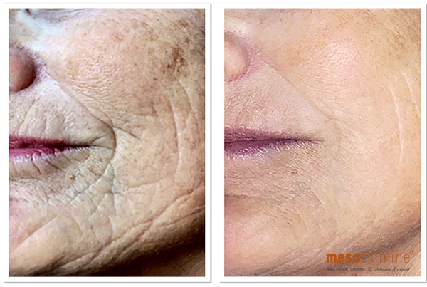 Illustration  MESO CHEEK LIFT+