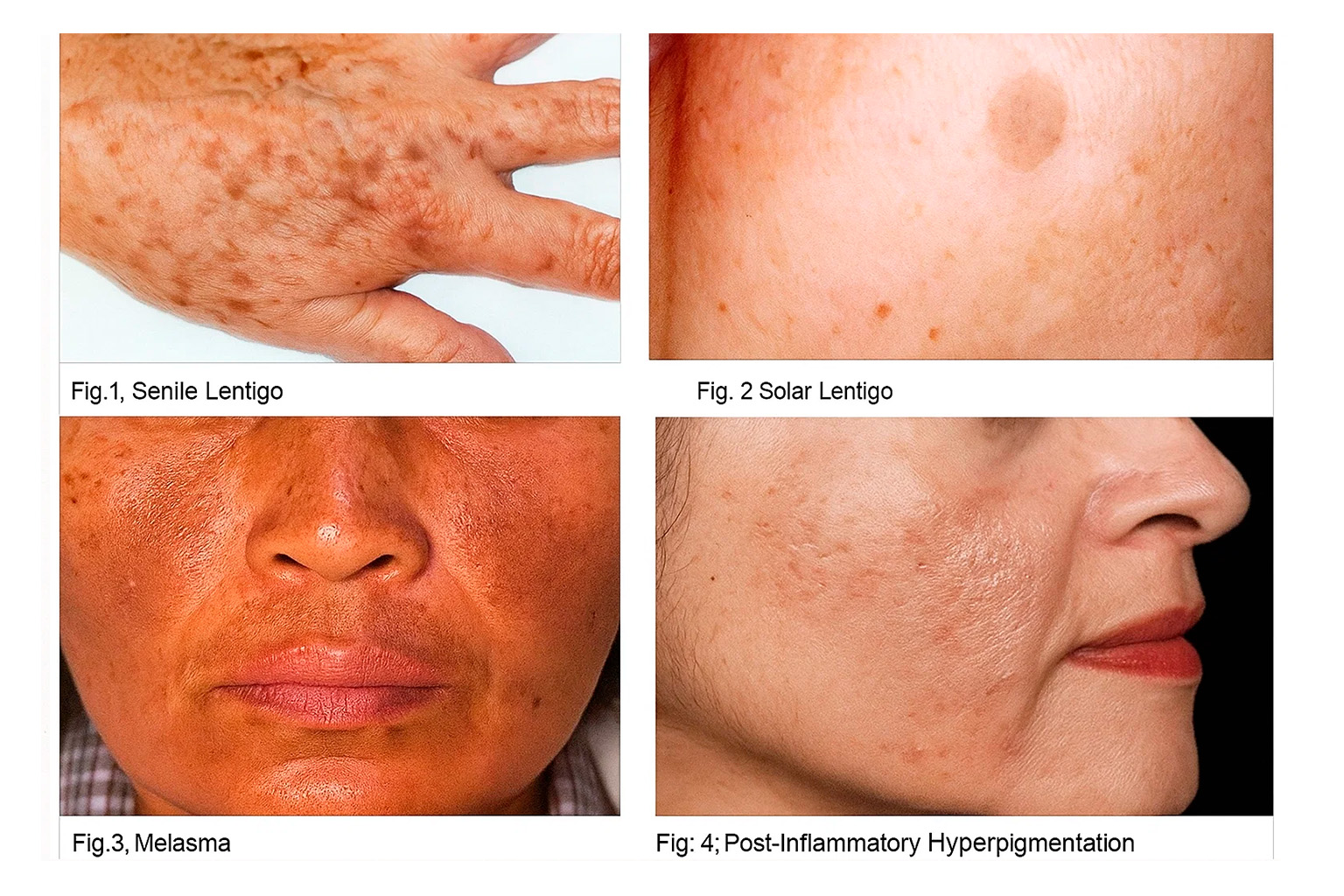 Illustration: skin pigmentation and color variations