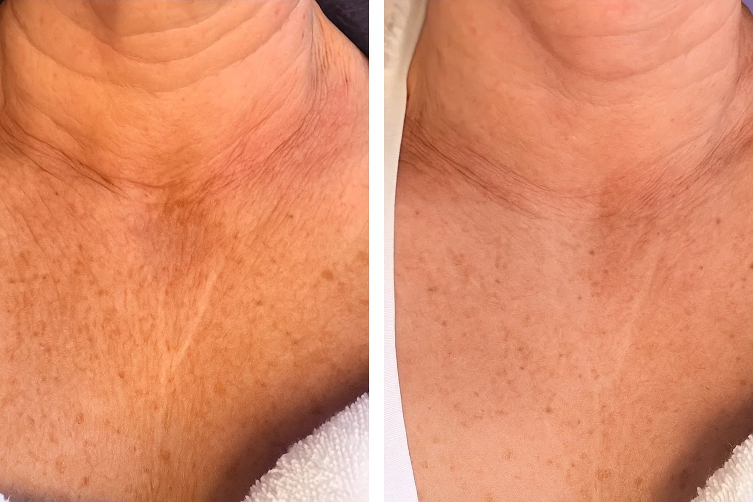 Meso Neck & Dcollet Lift  product view