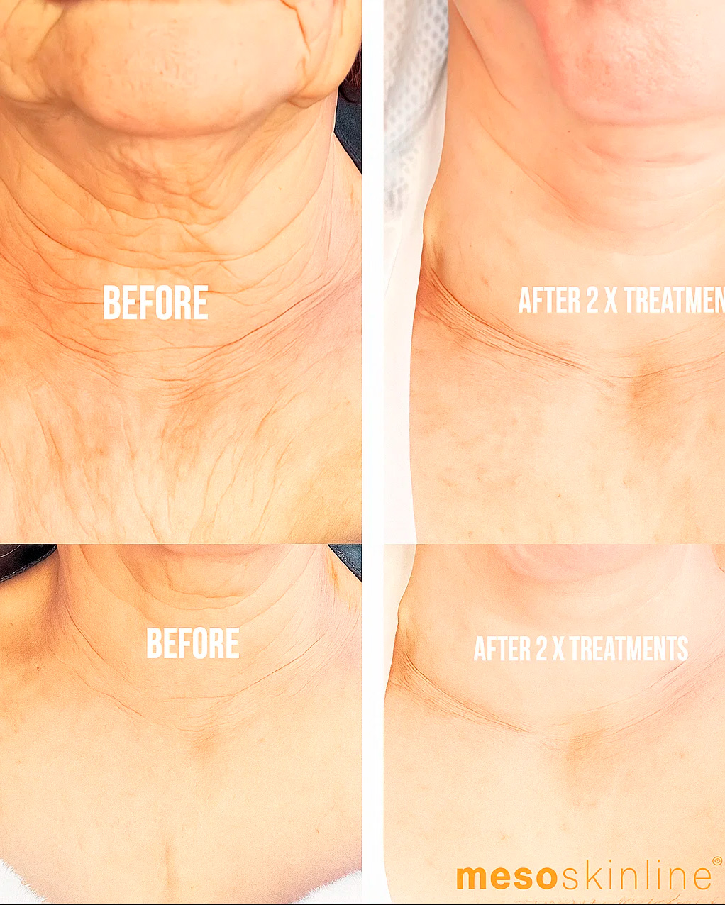 Meso Neck & Dcollet Lift applied to the cheek