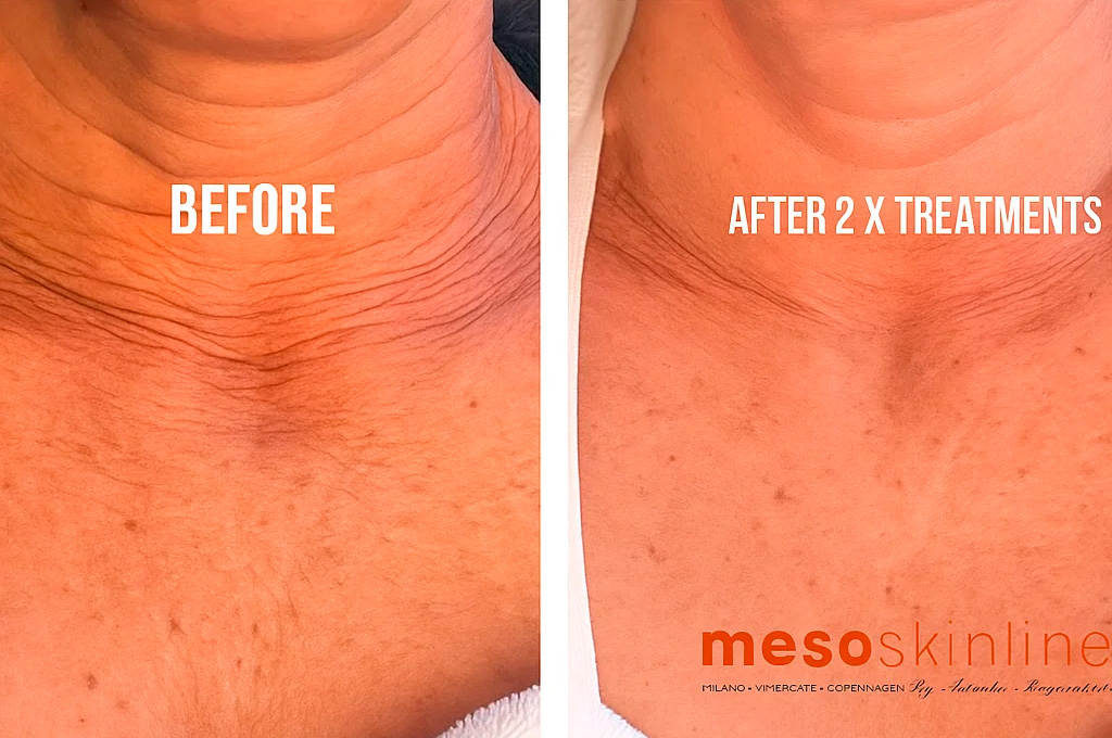 MESO NECK & DCOLLETE LIFT+ product