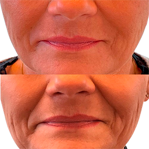 Meso Neck & Dcollet Lift auf der Wange angewendet