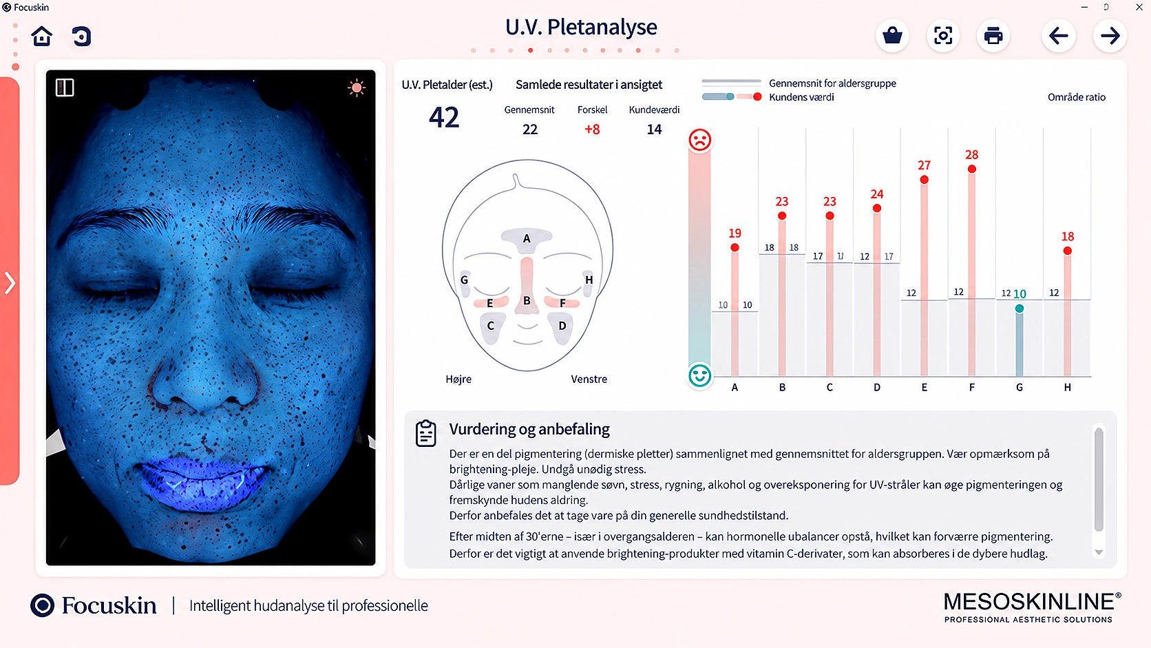 Focuskin analyse af UV pigmentering