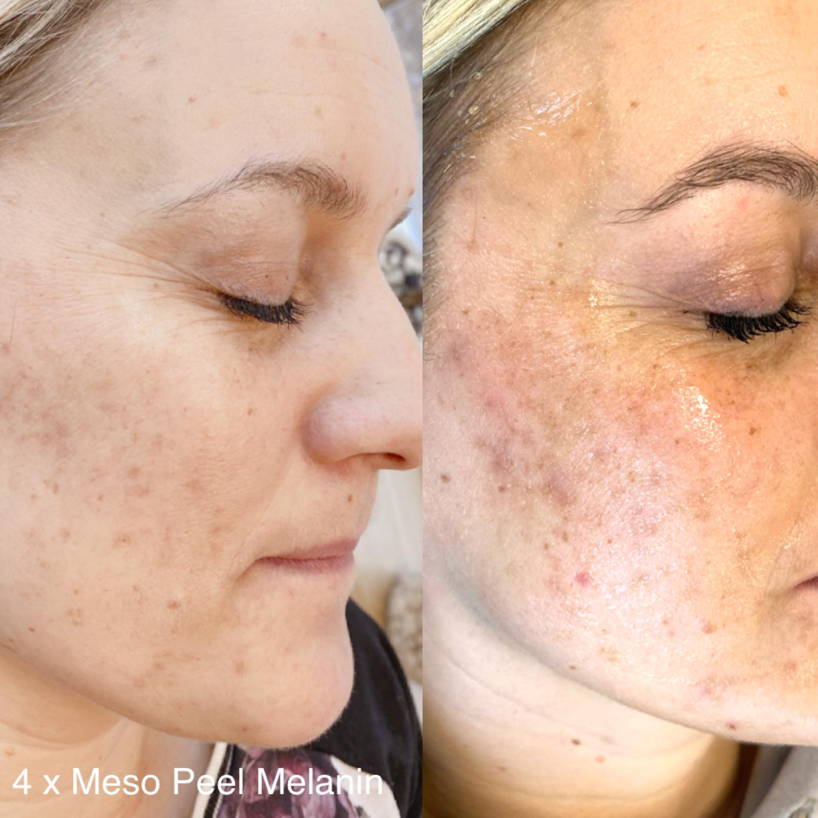 Before/after results