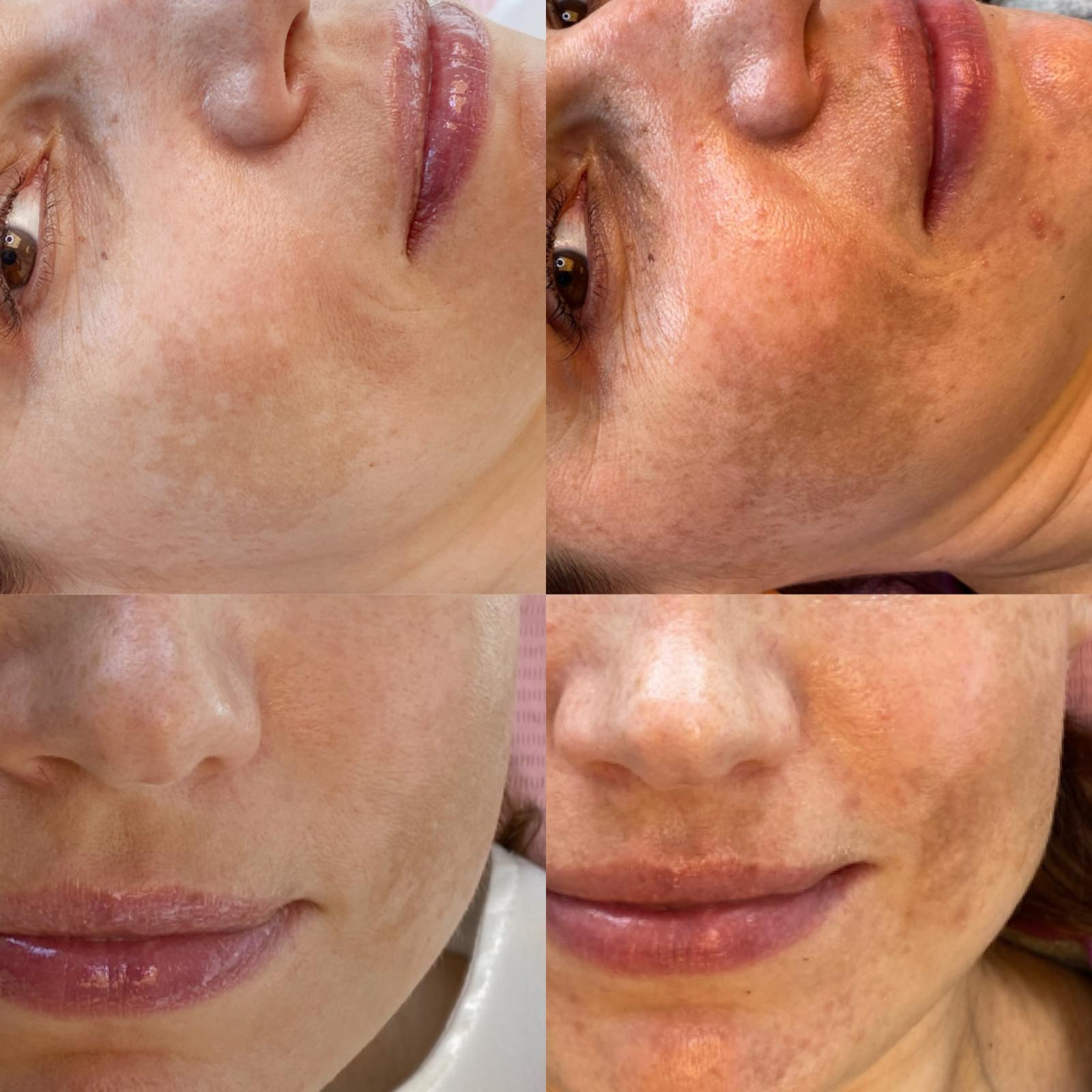 Clinical peel course