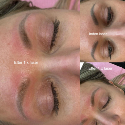 Kurs zum gtegeschalteten YAG-Laser (Kurs zur Entfernung von Ttowierungen und Permanent Make-up)