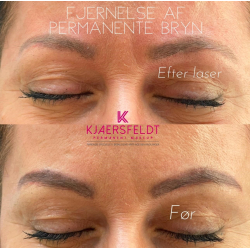 Kurs zum gtegeschalteten YAG-Laser (Kurs zur Entfernung von Ttowierungen und Permanent Make-up)