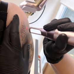 Kurs zum gtegeschalteten YAG-Laser (Kurs zur Entfernung von Ttowierungen und Permanent Make-up)