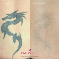 Kurs zum gtegeschalteten YAG-Laser (Kurs zur Entfernung von Ttowierungen und Permanent Make-up)