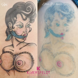 Kurs zum gtegeschalteten YAG-Laser (Kurs zur Entfernung von Ttowierungen und Permanent Make-up)