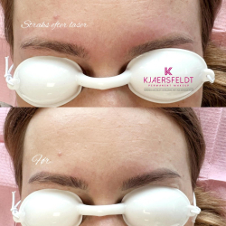 Kurs zum gtegeschalteten YAG-Laser (Kurs zur Entfernung von Ttowierungen und Permanent Make-up)