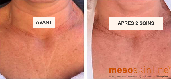 Meso Neck & D&eacute;collet&eacute; Lift &mdash; conditionnement