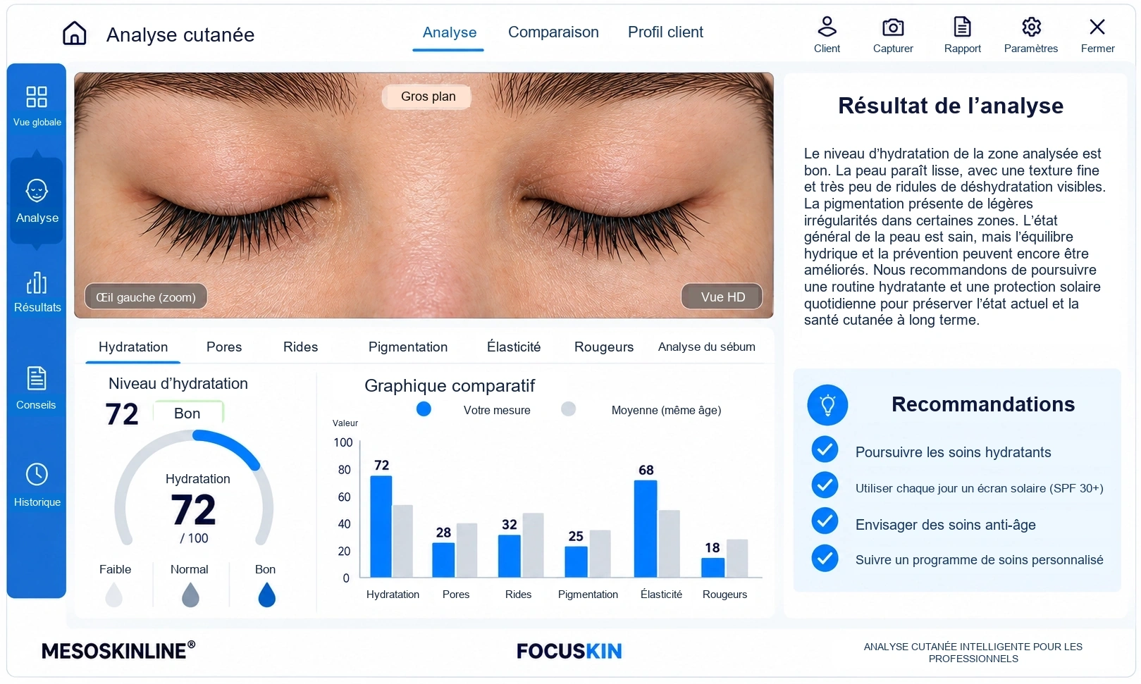 Analyse détaillée des rides avec Focuskin