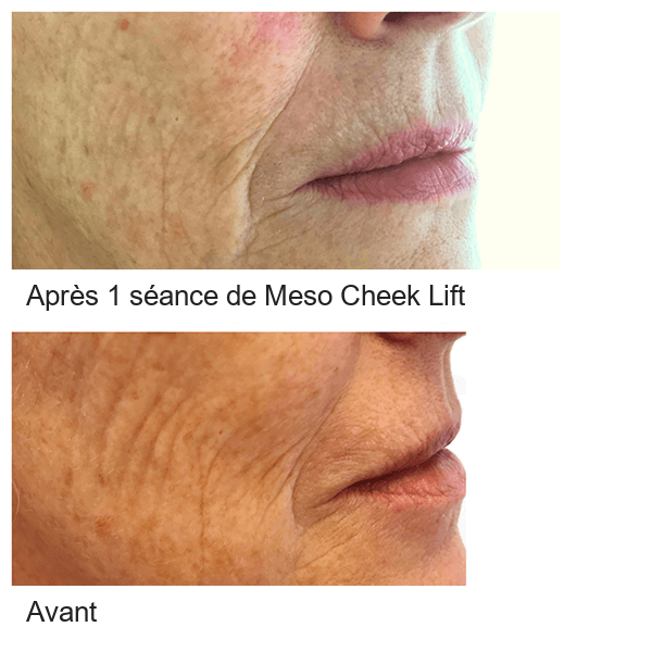 MESO CHEEK LIFT &mdash; collage de produits