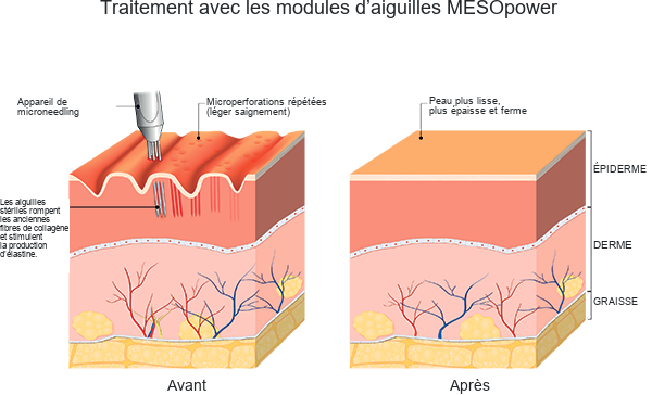 Illustration du MESOpower Pen
