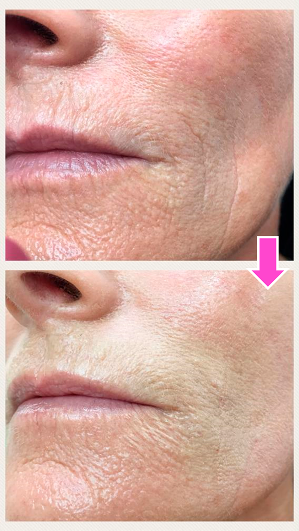 Sammenligning af huden omkring munden p� siden om Meso Fresh Vitamin