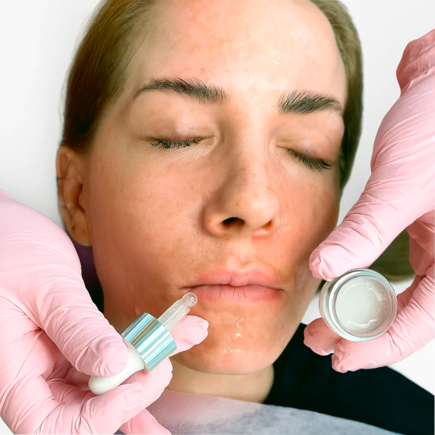 Bio Microneedling IDEALSKIN Masterkursus (ONLINE-THEORIE, PRAXISTRAINING IM SCHULUNGSZENTRUM)