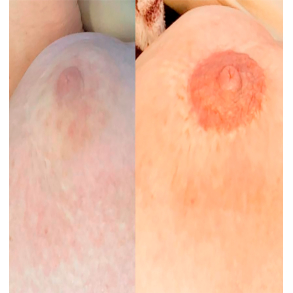 Medicinsk Pigmentering workshop for erfarne behandlere (Kombineret online undervisning og praktik)