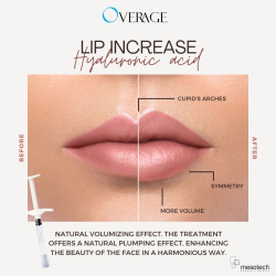 OVERAGE BLUE 1.0 ml (MESO)