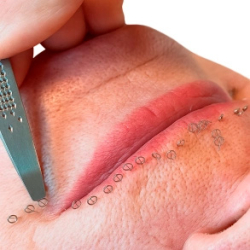 CPD-Certified Aculifting Course (Online course with or without a practical training day)