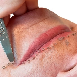 CPD-zertifizierter Aculifting-Kurs Online-kurs mit oder ohne praktischen Schulungstag)