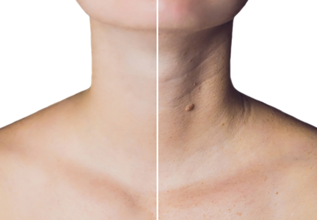 DÉCOLLÉTE AND NECK